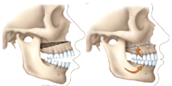 Correcting an open bite