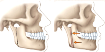 Correcting an open bite