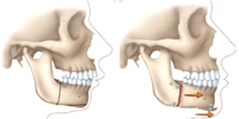 correcting a receding lower jaw or "weak chin"