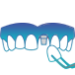 dental-implant-in-mumbai