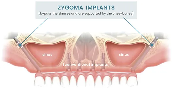 zygomatic implants