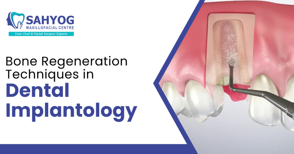 Bone Regeneration Technique In Dental Implantology
