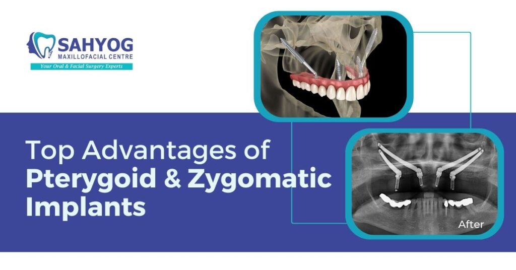 Zygomatic & Pterygoid implants