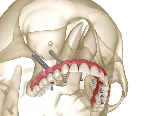 Pterygoid implants